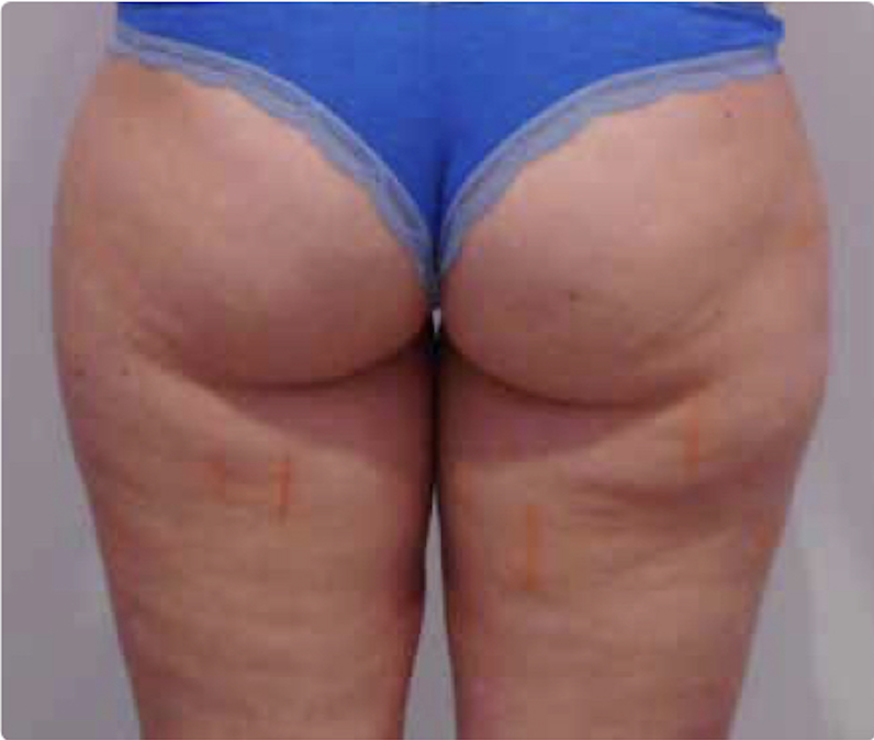 Cellulite — prima del trattamento